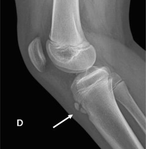 enfermedad osgood schlatter