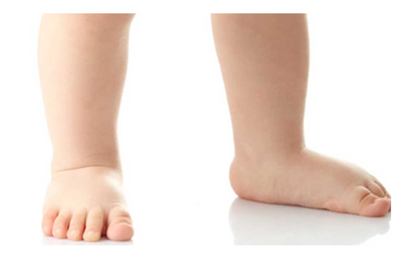 PIE PLANO LAXO INFANTIL