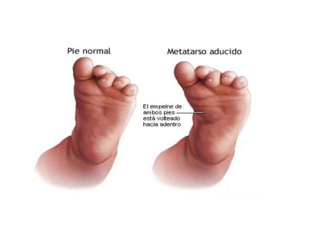 METATARSO ADUCTO