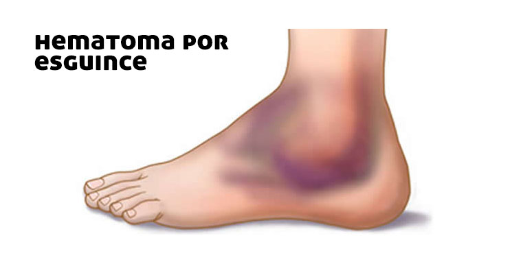 hinchazon-del-tobillo-por-esguince