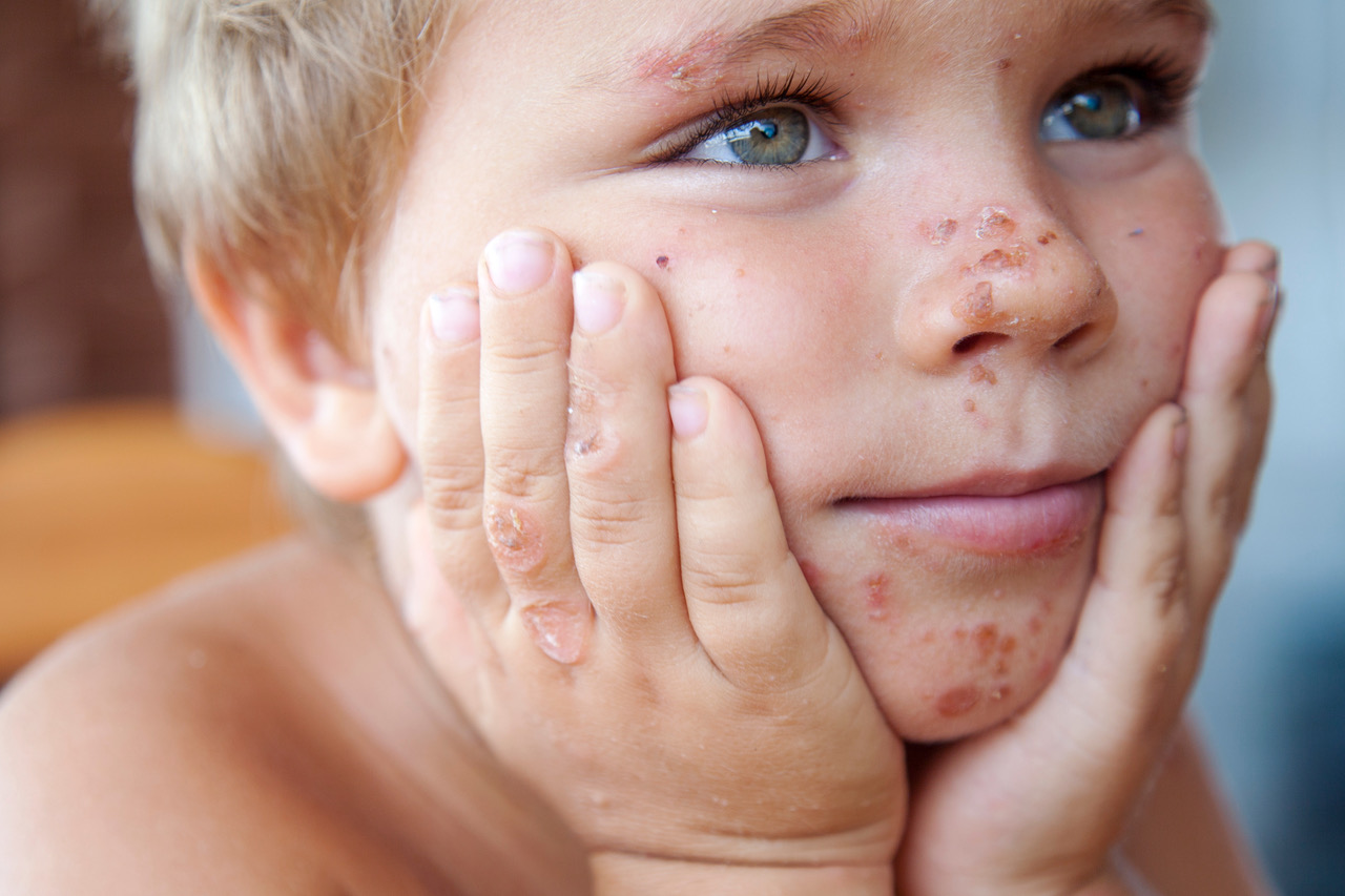 PSORIASIS EN NIÑOS